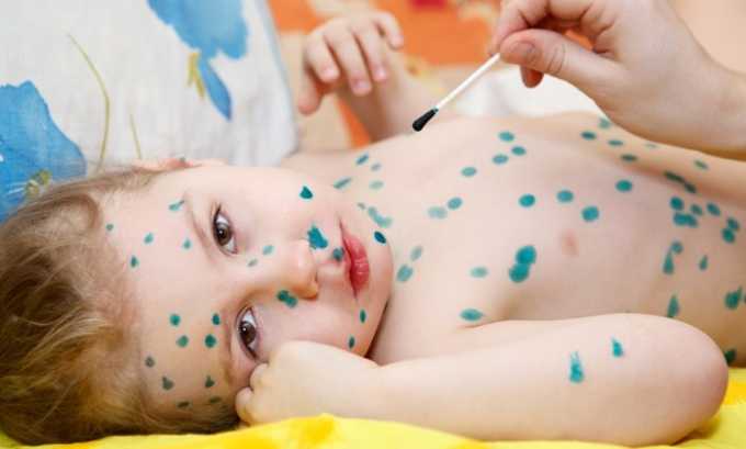 Поражения кожных покровов тела вызываются герпесвирусами, к ним можно отнести появление ветрянки у детей. В данном случае лечением назначает педиатр