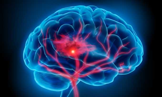 При остром и хроническом течении заболевания возможен поражение головного мозга