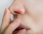 Симптомы и лечение герпеса в носу
