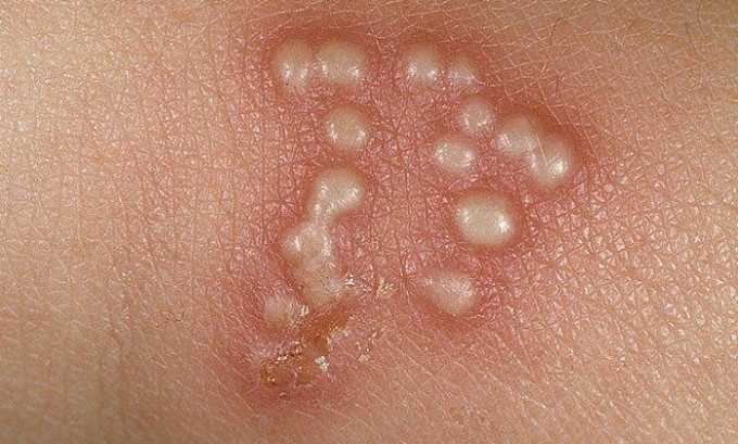 Главный симптом герпеса - сыпь, которая выглядит как пузырьки, заполненные прозрачной или мутной жидкостью