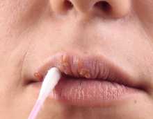 Способы лечения простуды на губах в домашних условиях