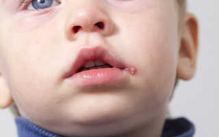 Появление герпеса на лице у ребенка: симптомы, причины, лечение