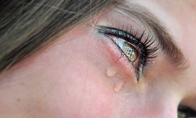 Когда областью поражения являются органы зрения, то возникает обильное слезотечение