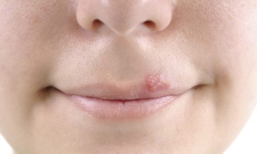 Мазь от герпеса на губах рекомендуется использовать после проявления первых признаков заболевания: пузырьковых высыпаний, зуда, покалывания, жжения, болезненных ощущений
