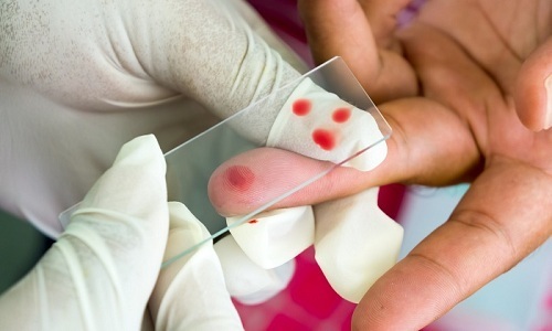 Общий анализ крови у ребенка при подозрении на герпес дополняют исследованием на антитела к вирусу