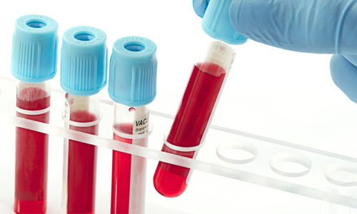 Исследование крови считается более информативным, т. к. помогает определить вирус простого герпеса даже при бессимптомном течении болезни