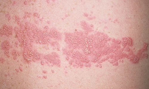 Герпес - заболевание, которое может проявиться в любом возрасте и на любом участке кожных покровов, в т. ч. на животе