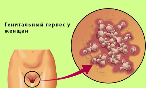Генитальным герпесом называется вирусное заболевание, передающееся половым путем и характеризующееся поражением половых губ, слизистой влагалища или матки