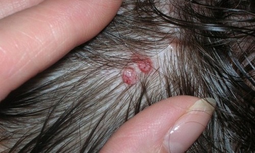 Герпес под волосами - тип вирусного поражения кожных покровов, возникающий на фоне активизации вируса 1 или 3 типа