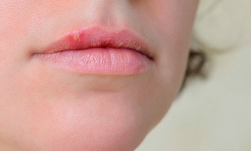 Предотвратить герпетические высыпания в области губ сложно, особенно если деятельность человека связана с чрезмерным нервным напряжением