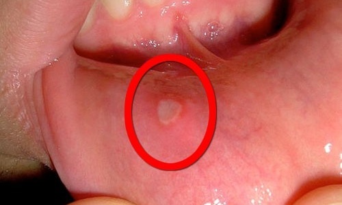 Герпетический стоматит - заболевание, спровоцированное вирусом герпеса 1 типа и характеризующееся высыпаниями на слизистых ротовой полости и гортани