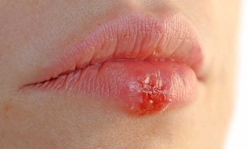 Проявления герпеса на губах в виде пузырьковой сыпи связаны с активизацией вируса простого герпеса (ВПГ) 1 типа, живущего в организме