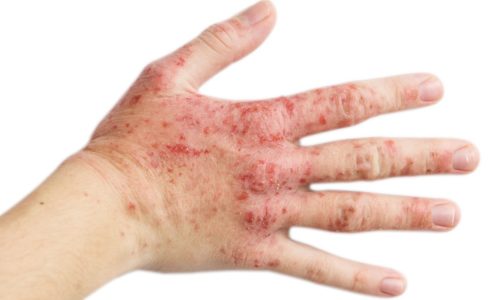 Вирус герпеса, поразивший кожу рук, опасен не только для самого больного, но и для окружающих