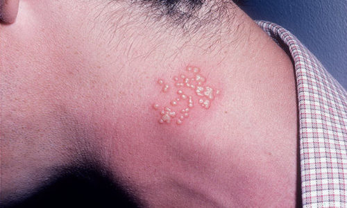 При неправильном лечении вирус, который локализуется, например, на лице, может распространиться на шею