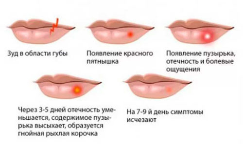 Такое распространенное заболевание, как герпес на губах, встречается у детей с раннего возраста