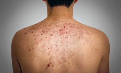 Герпес на коже спины возникает вследствие активации вируса, персистирующего в организме человека