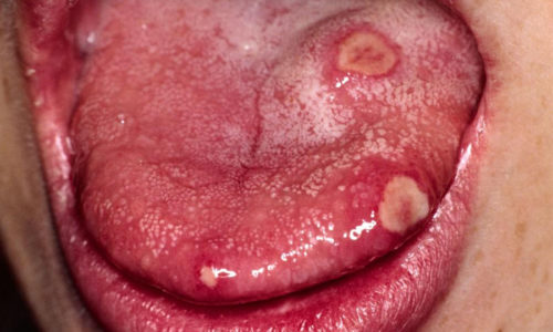 Герпетические высыпания на языке считаются симптомом вирусного стоматита
